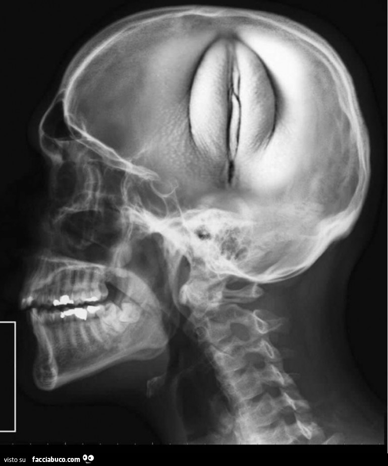 Figa nel cervello